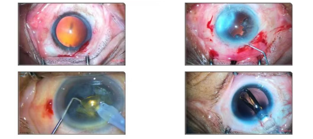 anterior surgery