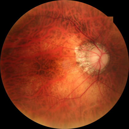 fundus image