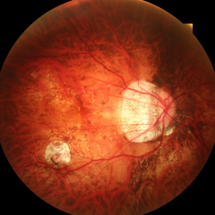 fundus photo