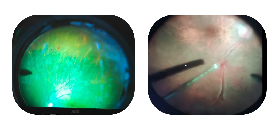 posterior surgeries