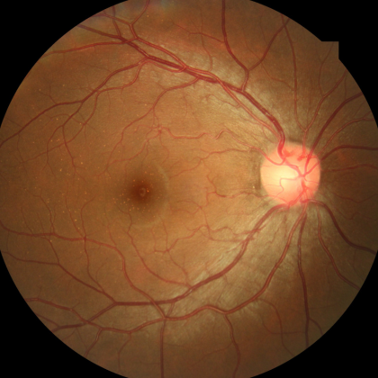 retina image