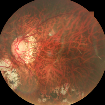 retinal disease