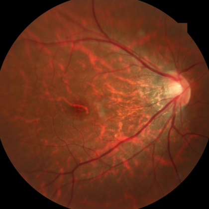 retinal image