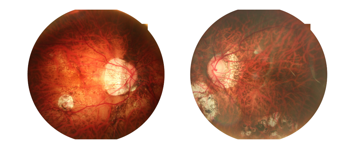 24 mega fundus images
