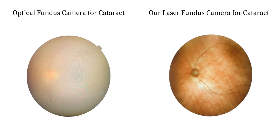 Cataract examination