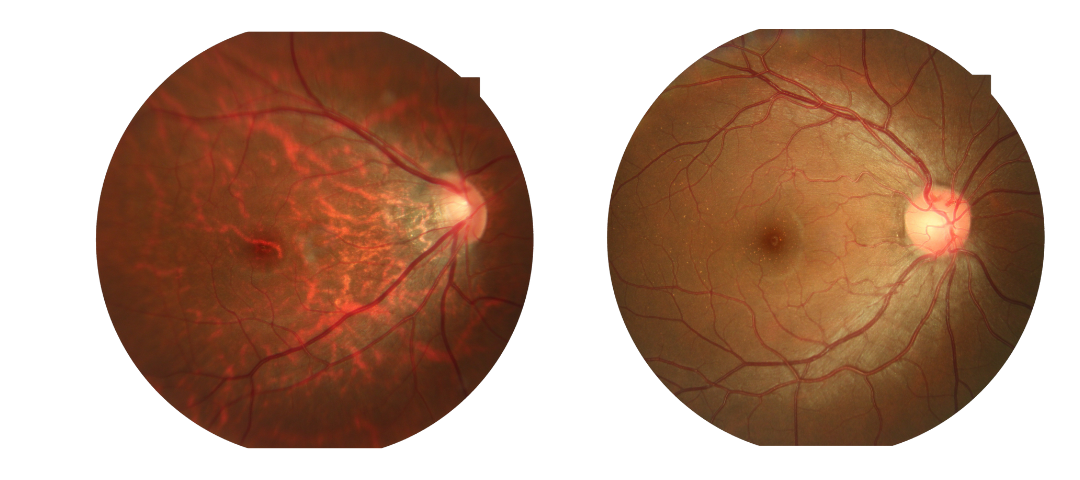 HD fundus image