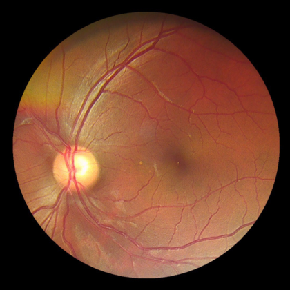 fundus image 1