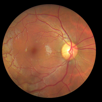 fundus image 4