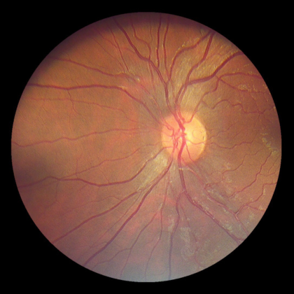 fundus image 2