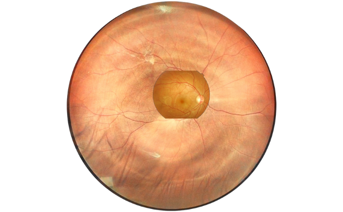 large view fundus image