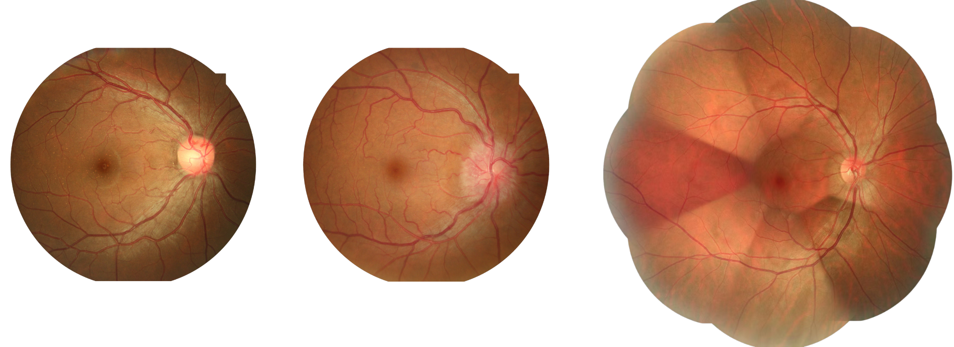 non-mydriatic fundus image