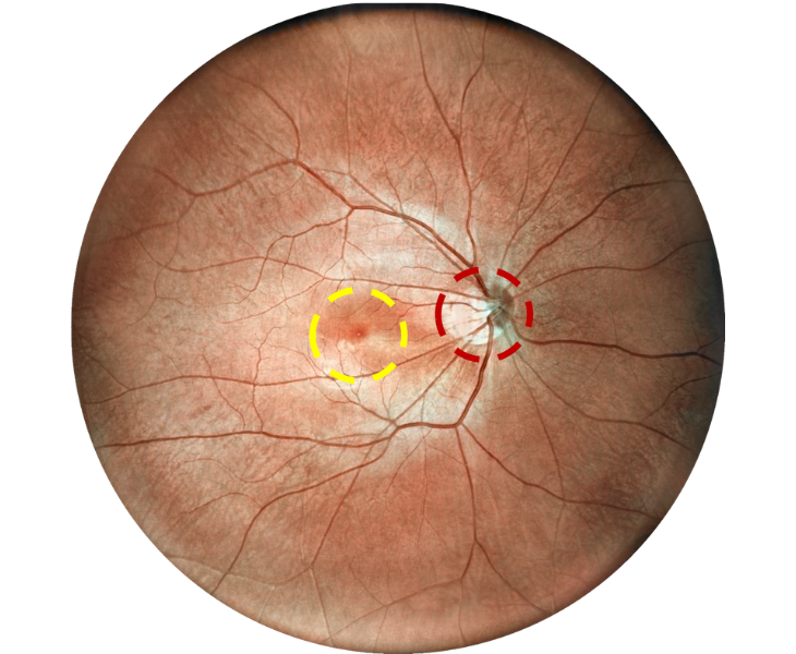 optic disc