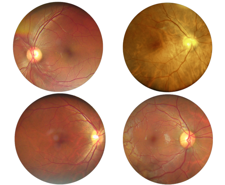 retina images