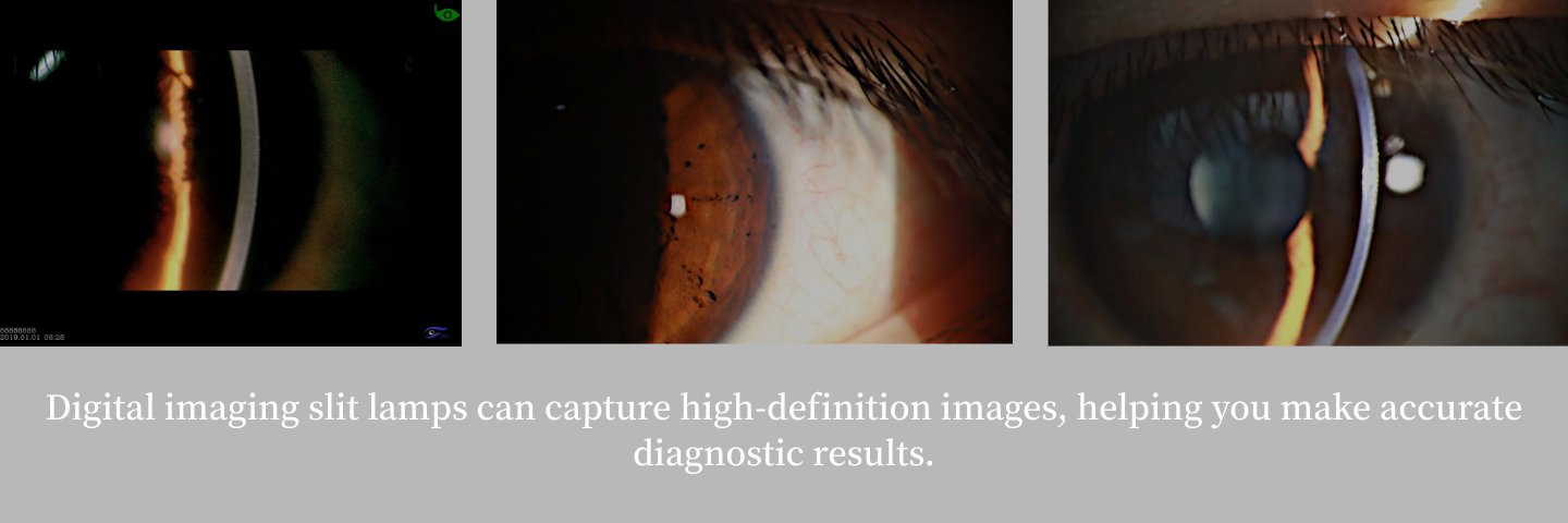 Slit lamp image