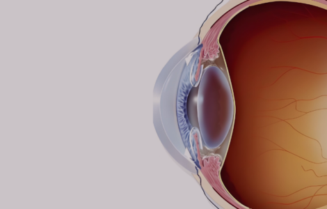glaucoma eye
