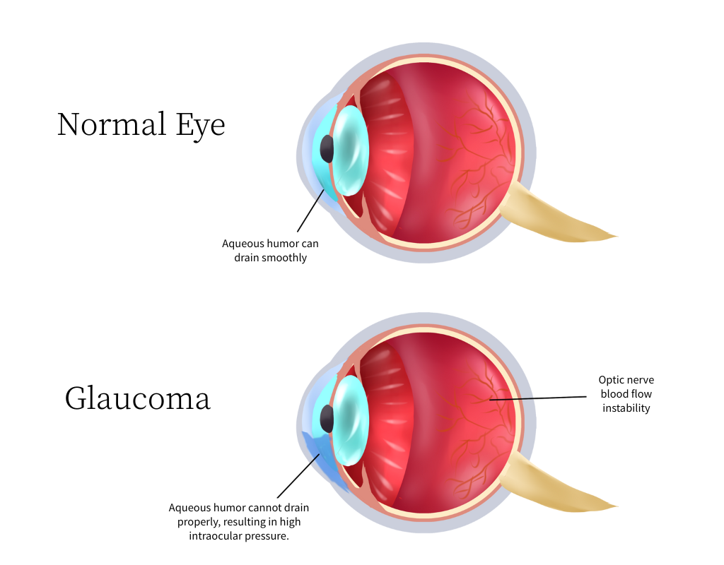 normal eye and glaucoma